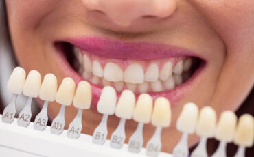 Imagem em Destaque - Facetas de porcelana em Ipaussu: quando esse tratamento é indicado para o seu caso