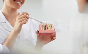 Imagem em Destaque - Implante dentário em Piraju: solução fixa para recuperar seu sorriso com segurança
