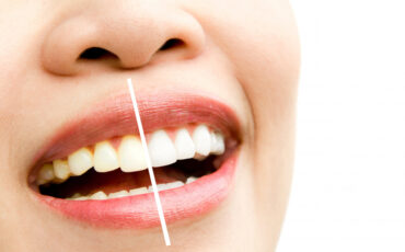 Imagem em Destaque - Clareamento dental em Santa Cruz do Rio Pardo: técnicas modernas para conquistar um sorriso mais branco e natural