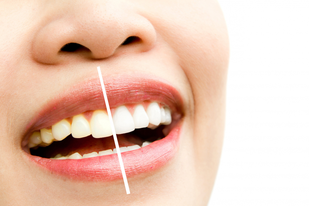 Clareamento dental em Santa Cruz do Rio Pardo: técnicas modernas para conquistar um sorriso mais branco e natural