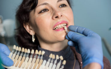Imagem em Destaque - Facetas de porcelana em Canitar: solução estética para transformar o sorriso com naturalidade e sofisticação