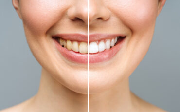 Imagem em Destaque - Clareamento dental em Jacarezinho: técnicas modernas para conquistar um sorriso mais branco e natural
