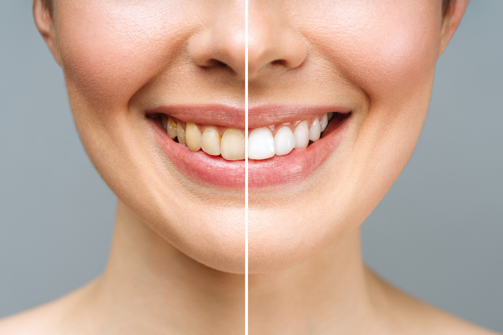 Clareamento dental em Jacarezinho: técnicas modernas para conquistar um sorriso mais branco e natural
