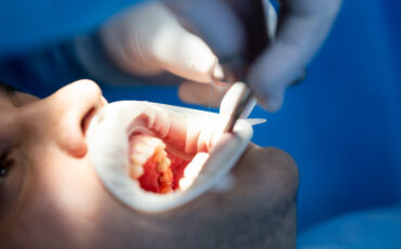 Extração de dente em Piraju: procedimento seguro para aliviar dores e preservar sua saúde bucal