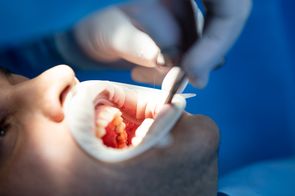 Extração de dente em Piraju: procedimento seguro para aliviar dores e preservar sua saúde bucal
