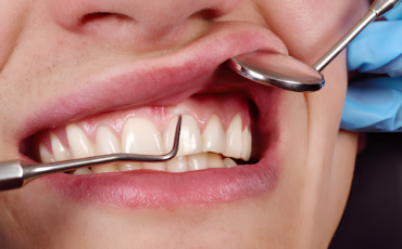 Imagem em Destaque - Gengivoplastia valor em Ourinhos: procedimento estético para harmonizar o sorriso com segurança