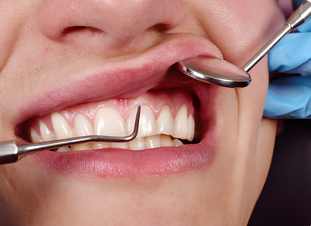 Gengivoplastia valor em Ourinhos: procedimento estético para harmonizar o sorriso com segurança