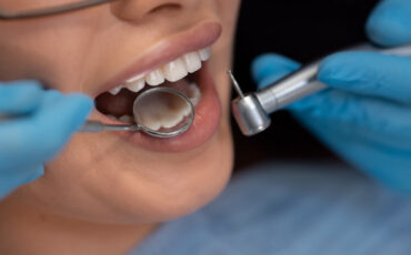Imagem em Destaque - Restauração dentária preço em Bandeirantes: saiba o que influencia o valor do tratamento e quando vale a pena investir