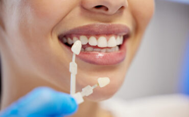 Facetas de porcelana em Carlópolis: veja quando este tratamento é a melhor opção para transformar o seu sorriso