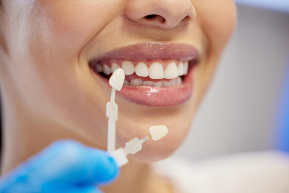 Facetas de porcelana em Carlópolis: veja quando este tratamento é a melhor opção para transformar o seu sorriso